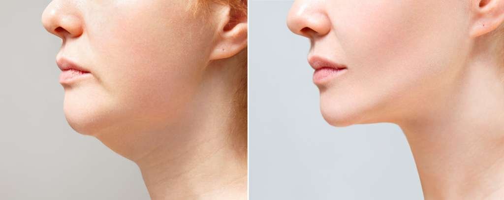 Chin Contouring Service