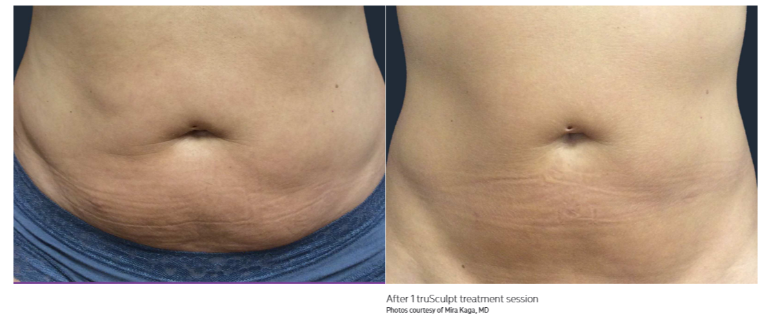 truSculpt Results Miami