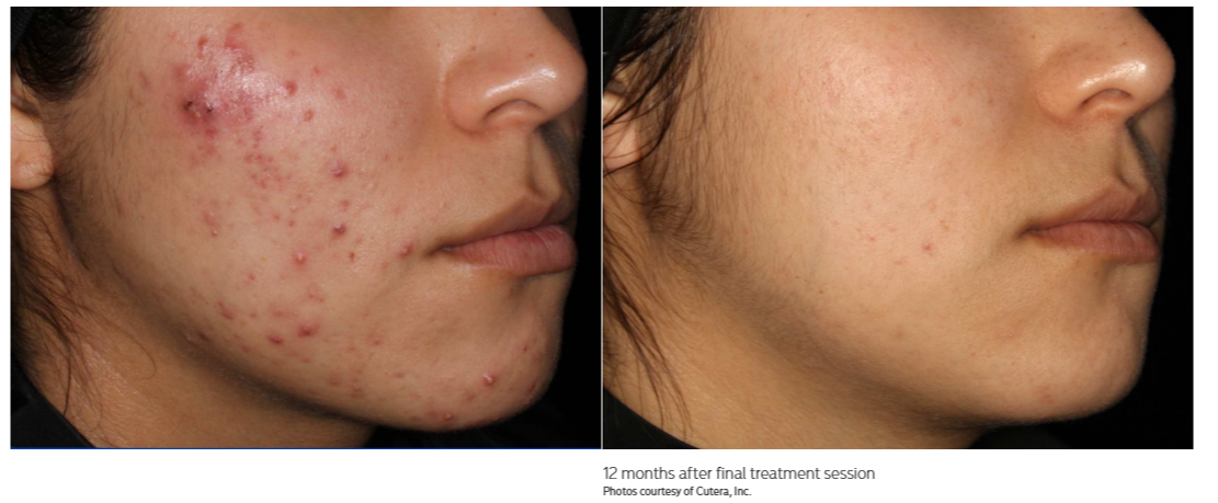 truBody Results Miami