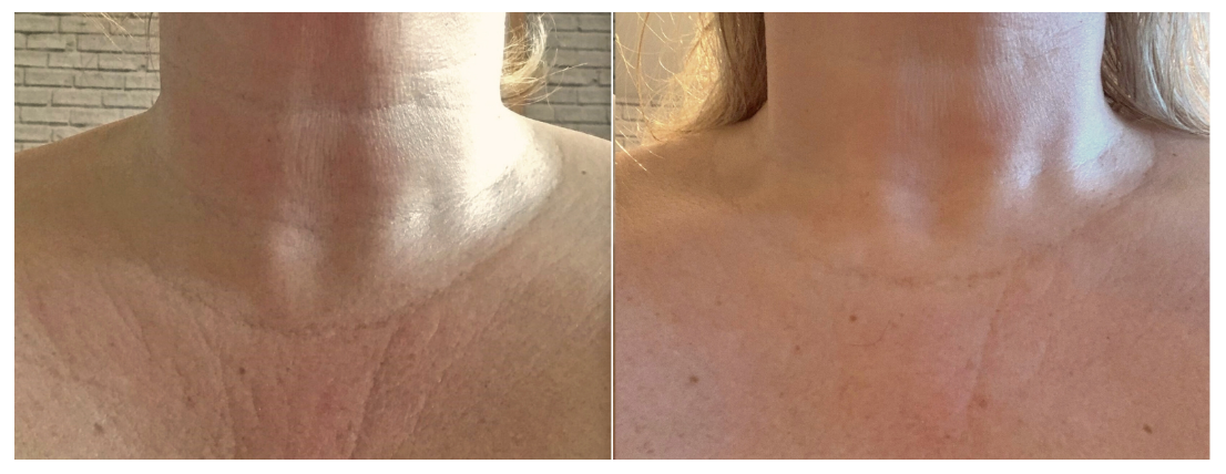 truBody Results Miami