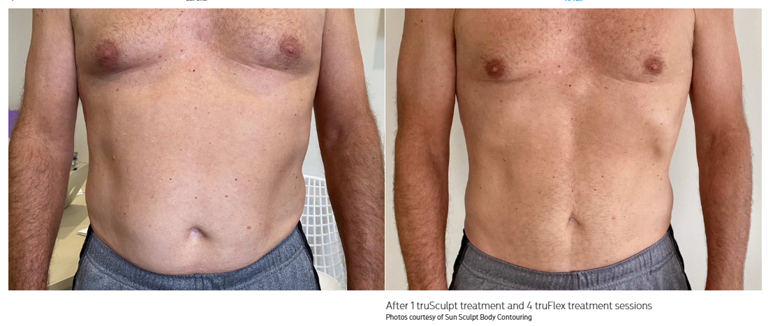 truSculpt Results Miami