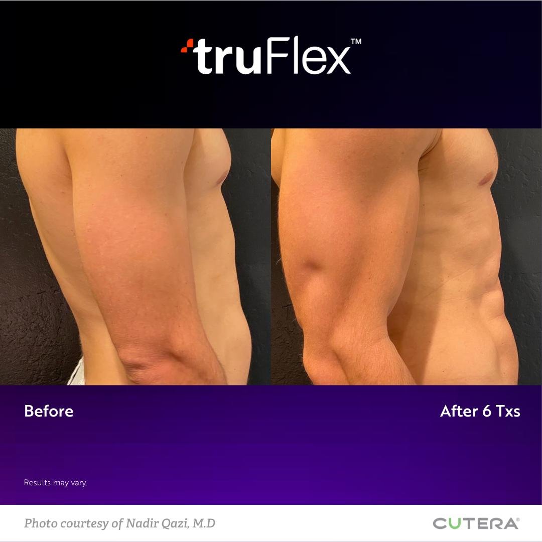 truFlex Treatment Miami