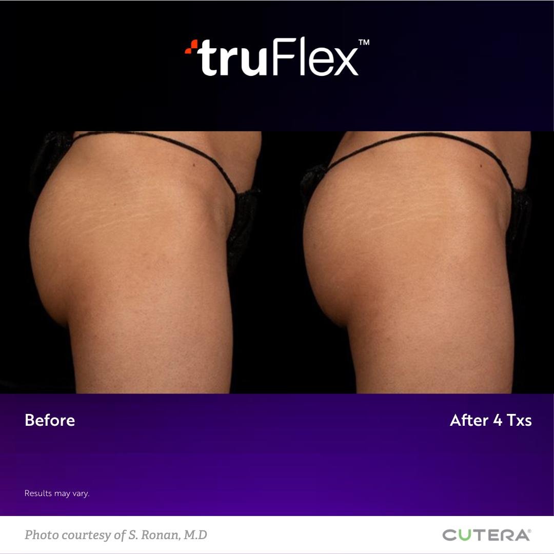 truFlex Results Miami