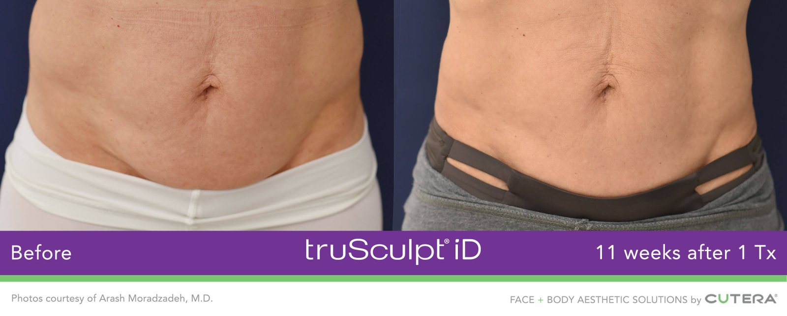 TruSculpt Treatment Miami