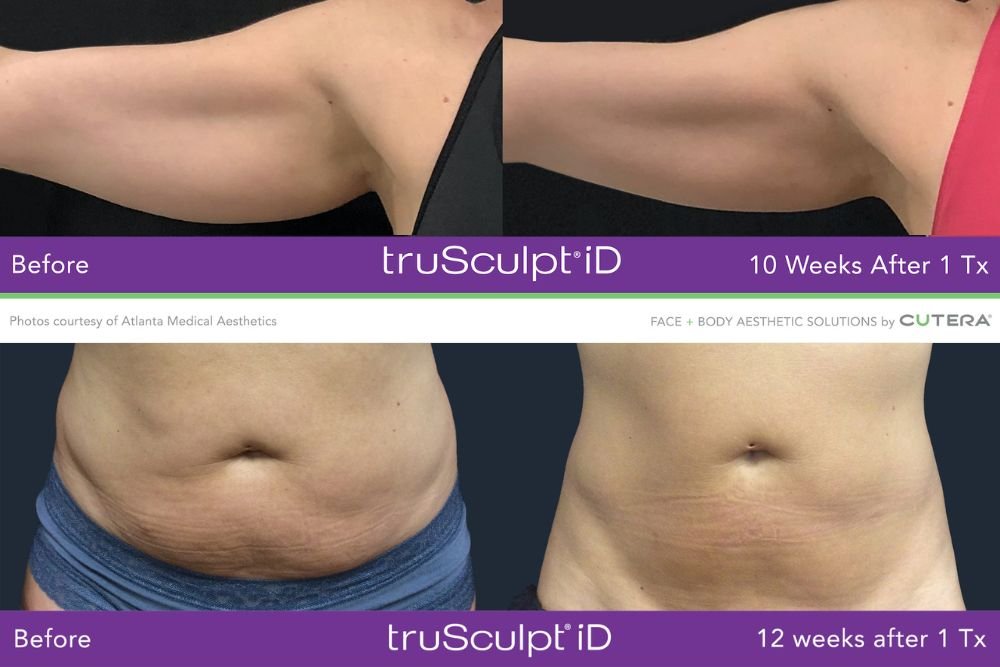 TruSculpt Results Miami